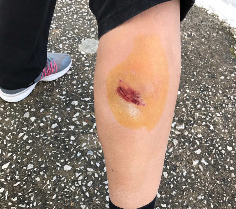 Αδέσποτο δάγκωσε και τραυμάτισε γυναίκα στους Γαργαλιάνους