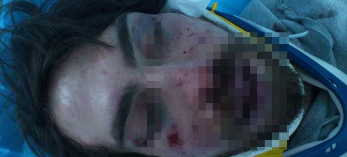 Συνελήφθη 42χρονος μετακλητός υπάλληλος της Χρυσής Αυγής με βαριές κατηγορίες για άγριο ξυλοδαρμό φοιτητή!