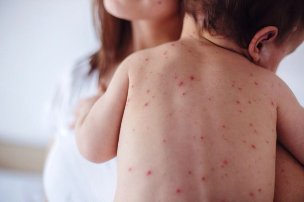 Μεμονωμένο το κρούσμα ιλαράς στη Μεσσηνία,  με την υγεία του παιδιού να εξελίσσεται πολύ καλά