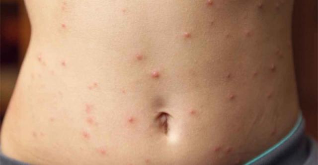 Άλλα 10 κρούσματα ιλαράς το Μάρτιο στη Μεσσηνία